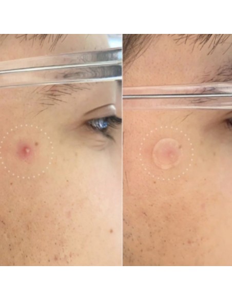 Przezroczyste plastry na wypryski Hero Mighty Patch Invisible+ 24 szt. 5010724000434 10